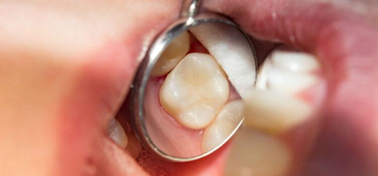 ‘No-drill’ dentistry stops tooth decay
