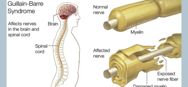Not only blood clots? EMA ‘assessing reports’ of AstraZeneca jab link to rare IMMUNE DISORDER