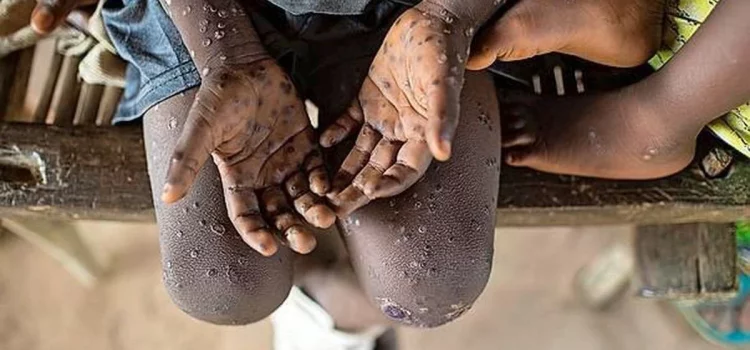 Monkeypox the new pandemic?