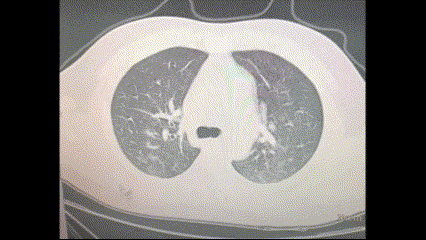 COVID Patients in China Developing ‘White Lung’ Syndrome